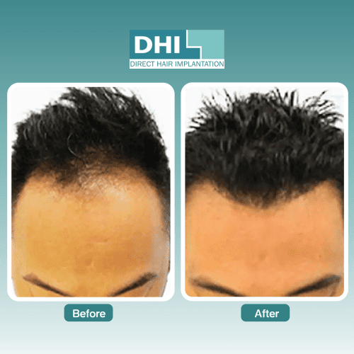 before-after-dhi