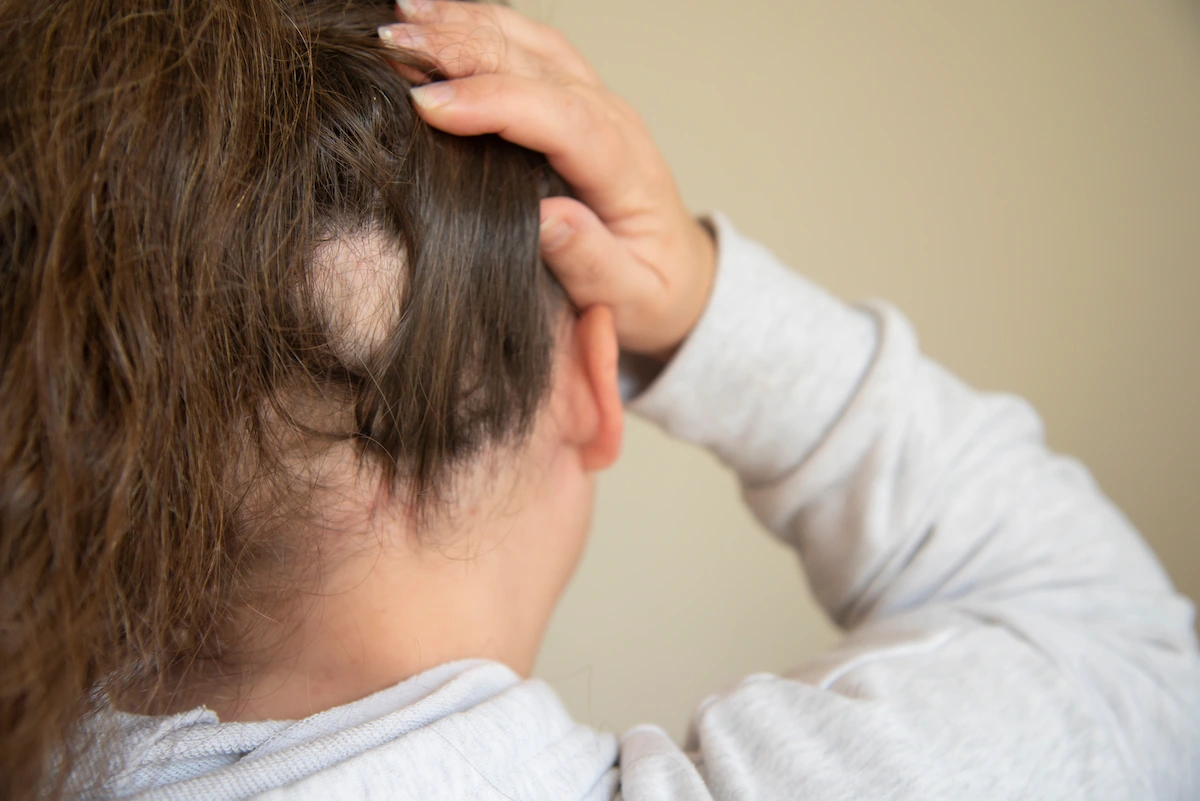 Non-Scarring Alopecia