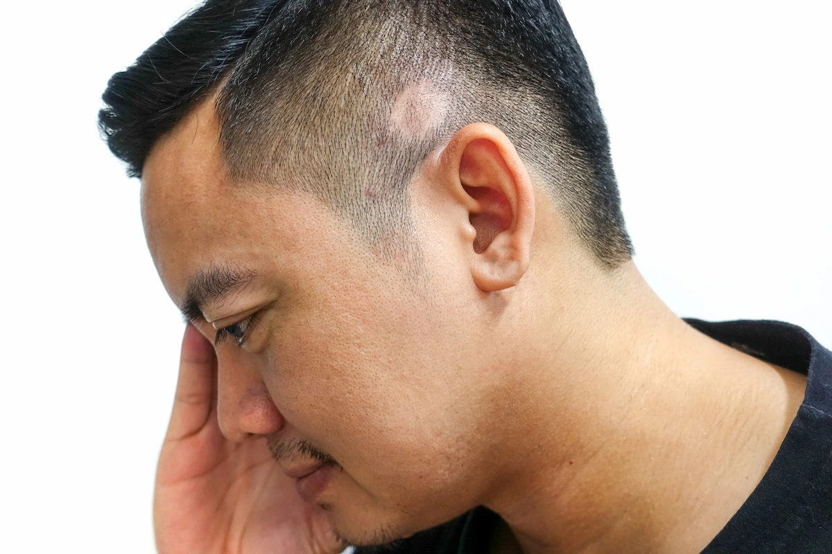 Scarring Alopecia