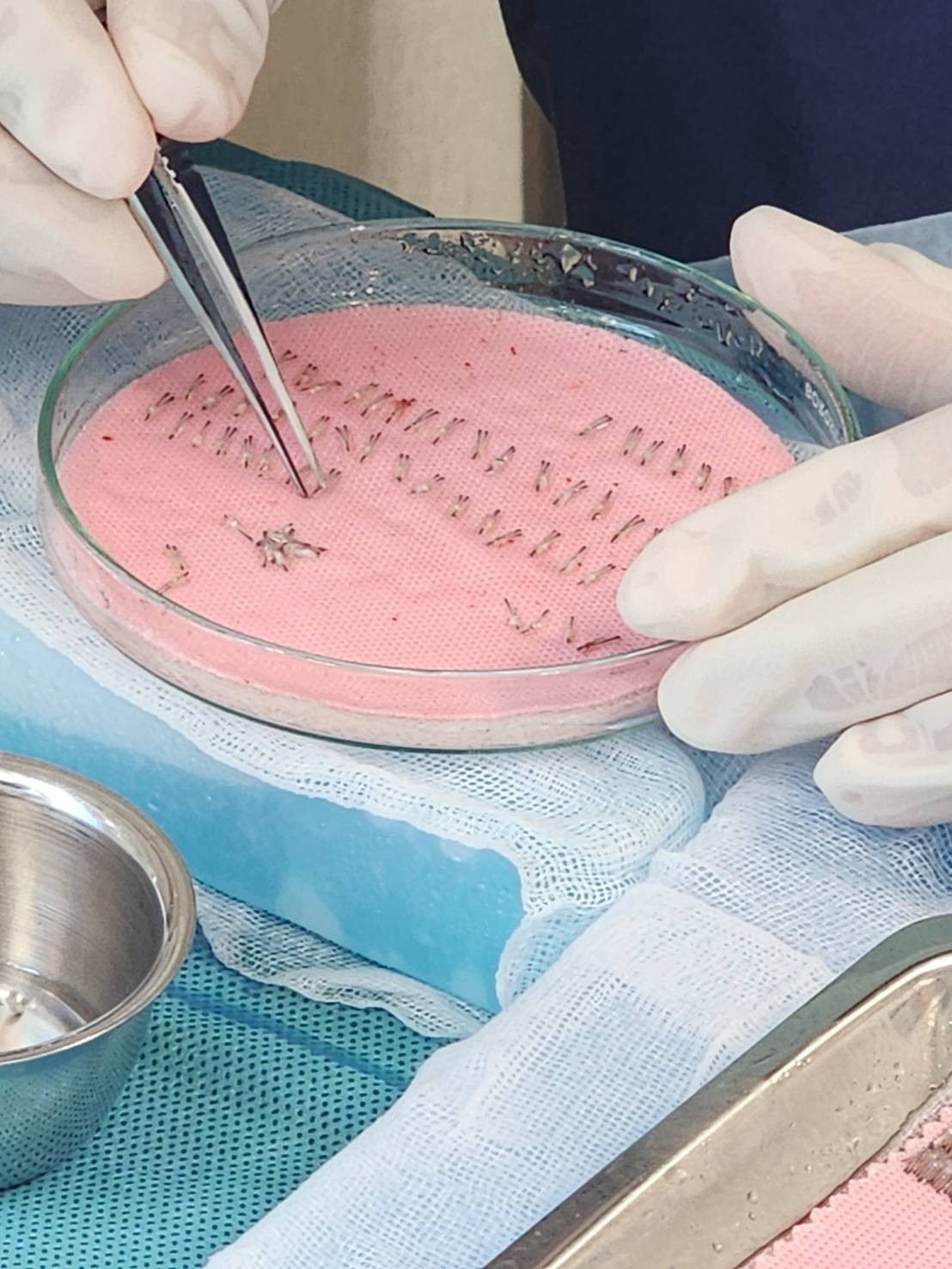 Pros of Hair Transplant for Women