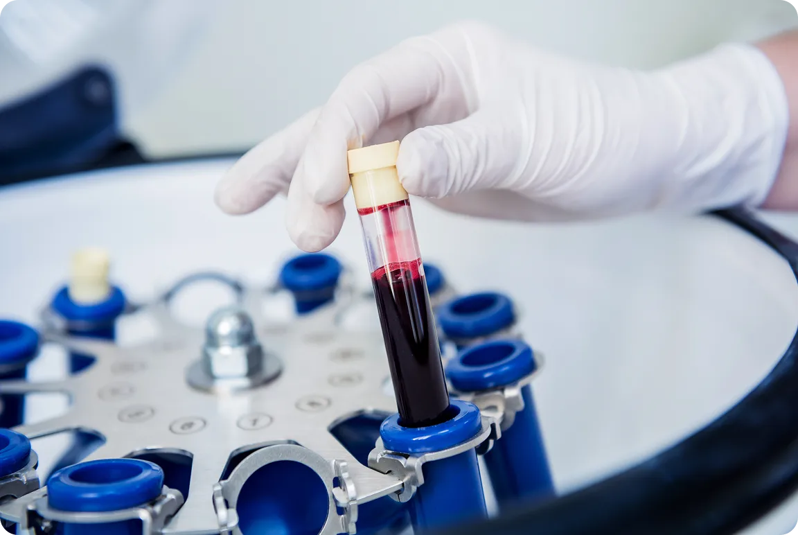 platelet-rich-plasma-preparation-tube-with-blood-hands