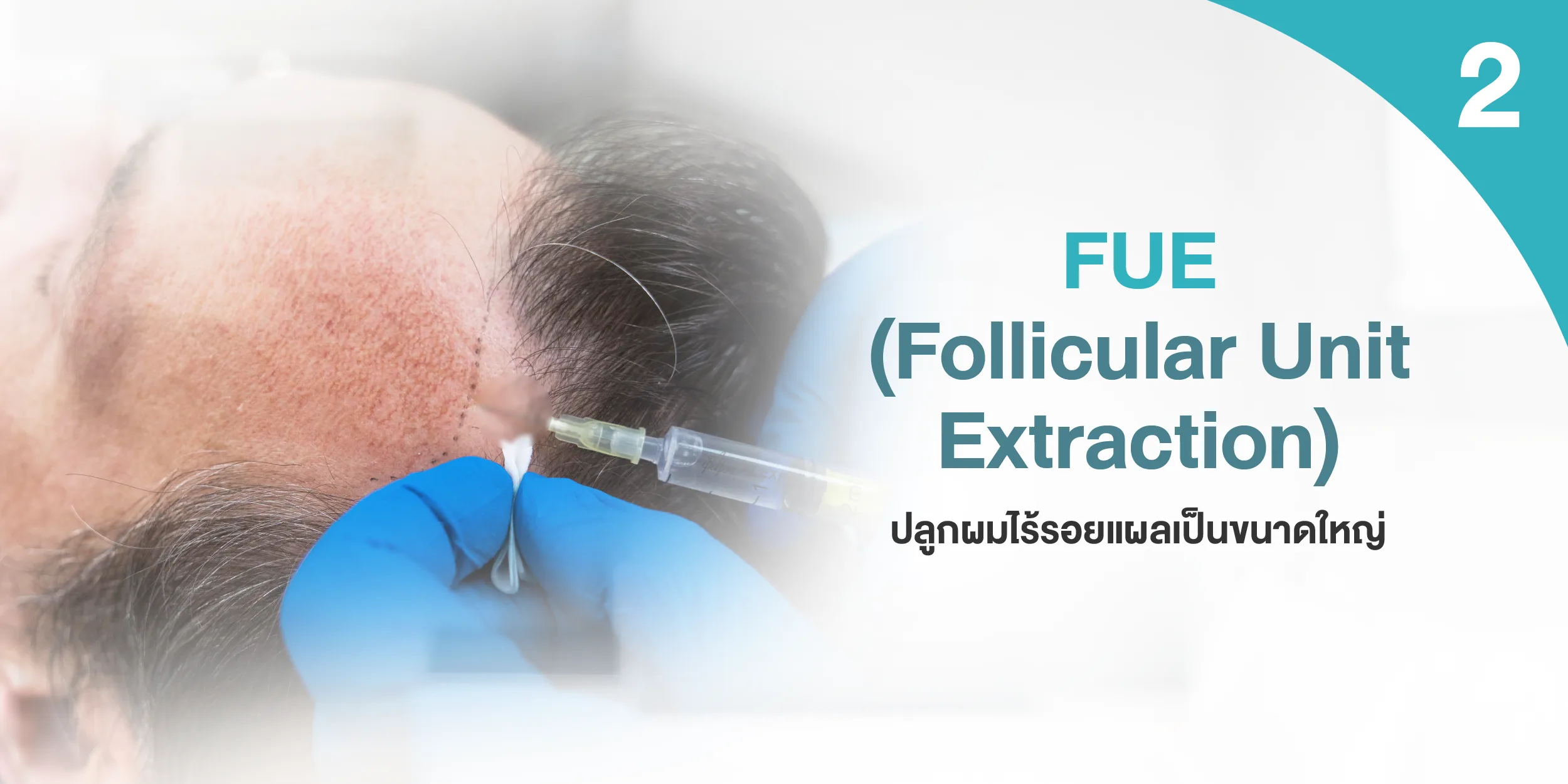 FUE (Follicular Unit Extraction)
