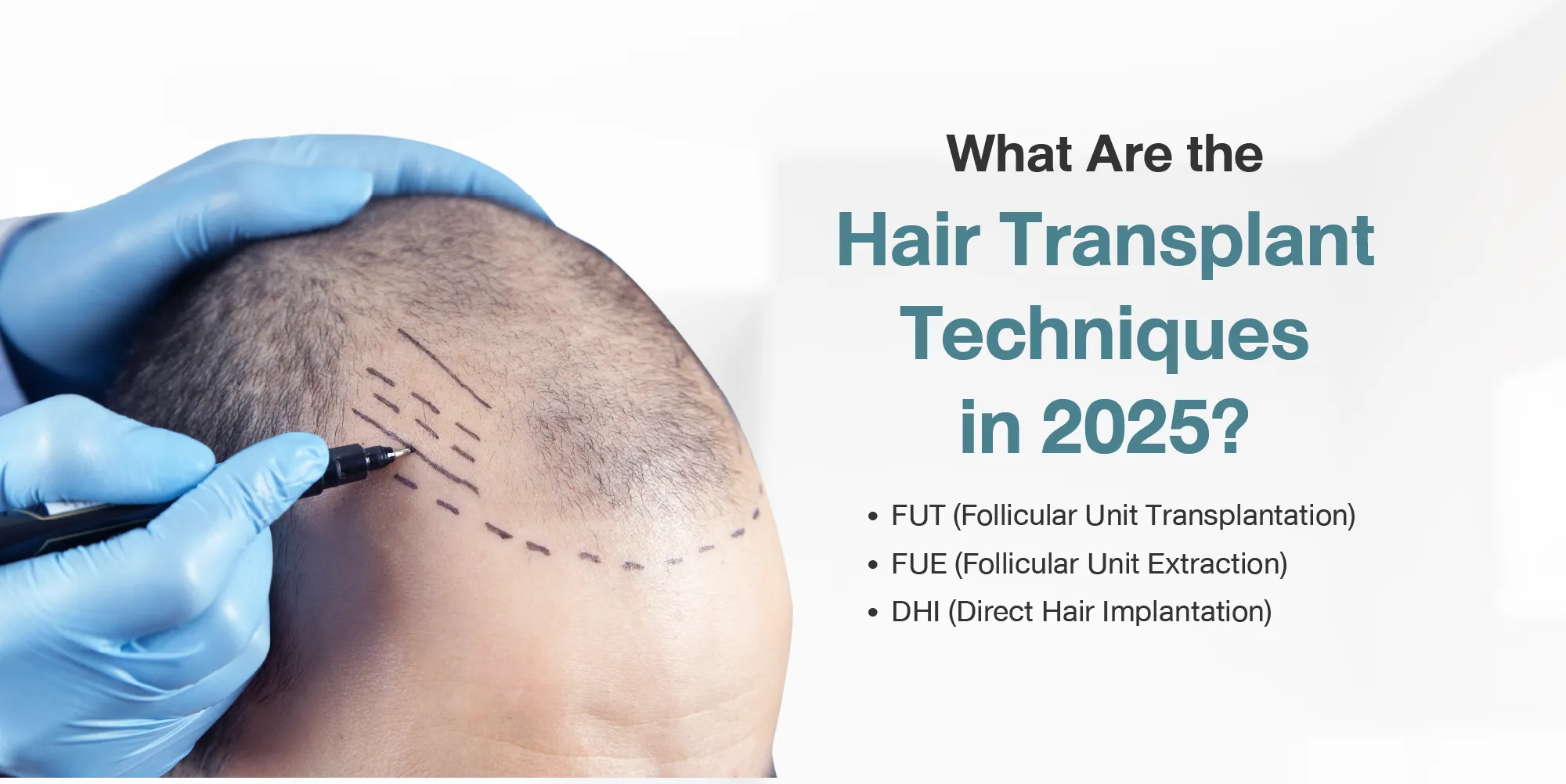 What Are the Top Hair Transplant Techniques in 2025