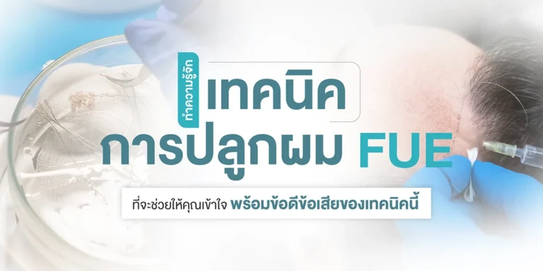 ทำความรู้จักเทคนิคการปลูกผม FUE ที่จะช่วยให้คุณเข้าใจ พร้อมข้อดีข้อเสียของเทคนิคนี้