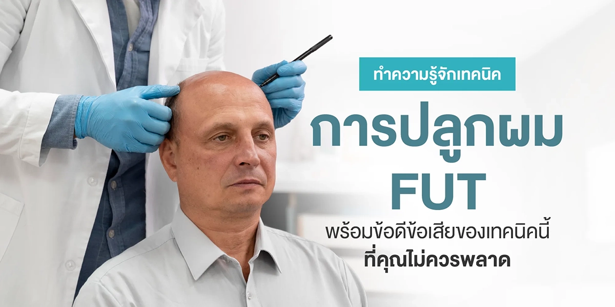 ปลูกผม FUT