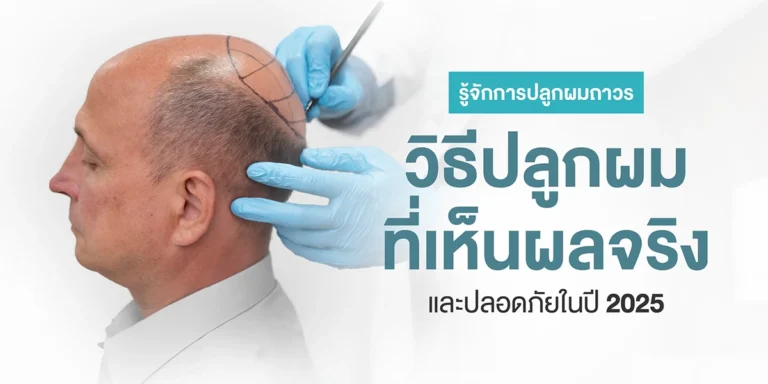 รู้จักการปลูกผมถาวร วิธีปลูกผมที่เห็นผลจริงและปลอดภัยในปี 2025