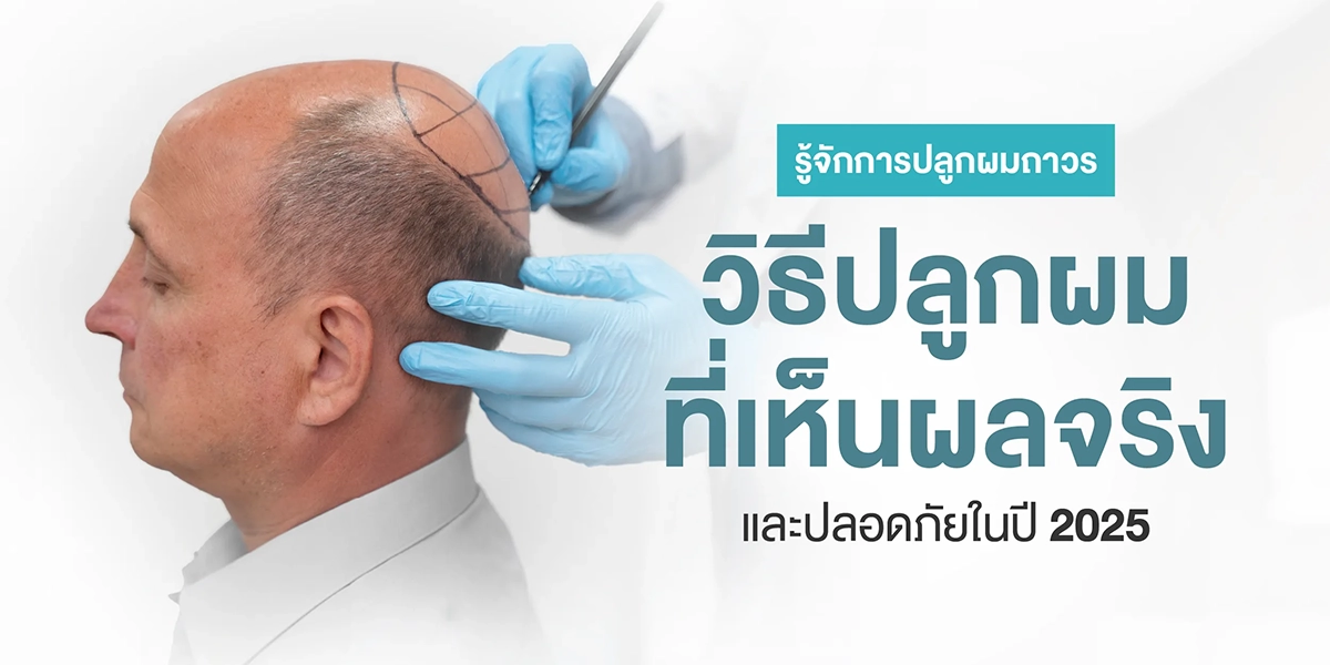 ปลูกผมถาวร