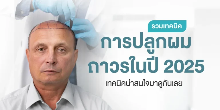 รวมเทคนิคการปลูกผมถาวรในปี 2025 เทคนิคน่าสนใจมาดูกันเลย