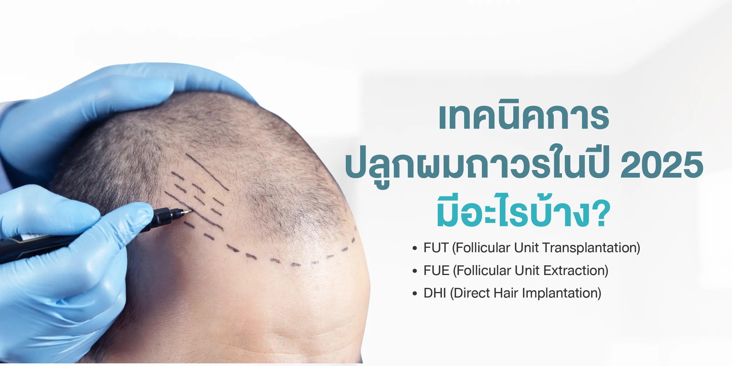 เทคนิคการปลูกผมถาวรในปี 2025