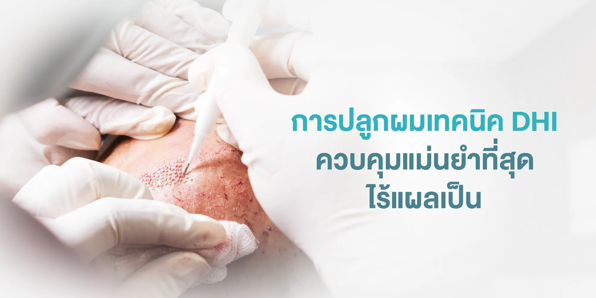 การปลูกผมเทคนิค DHI ควบคุมแม่นยำที่สุด ไร้แผลเป็น