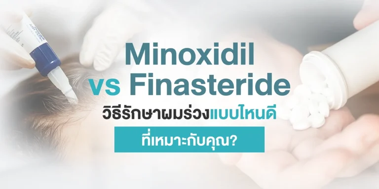 Minoxidil vs Finasteride วิธีรักษาผมร่วงแบบไหนดี ที่เหมาะกับคุณ?