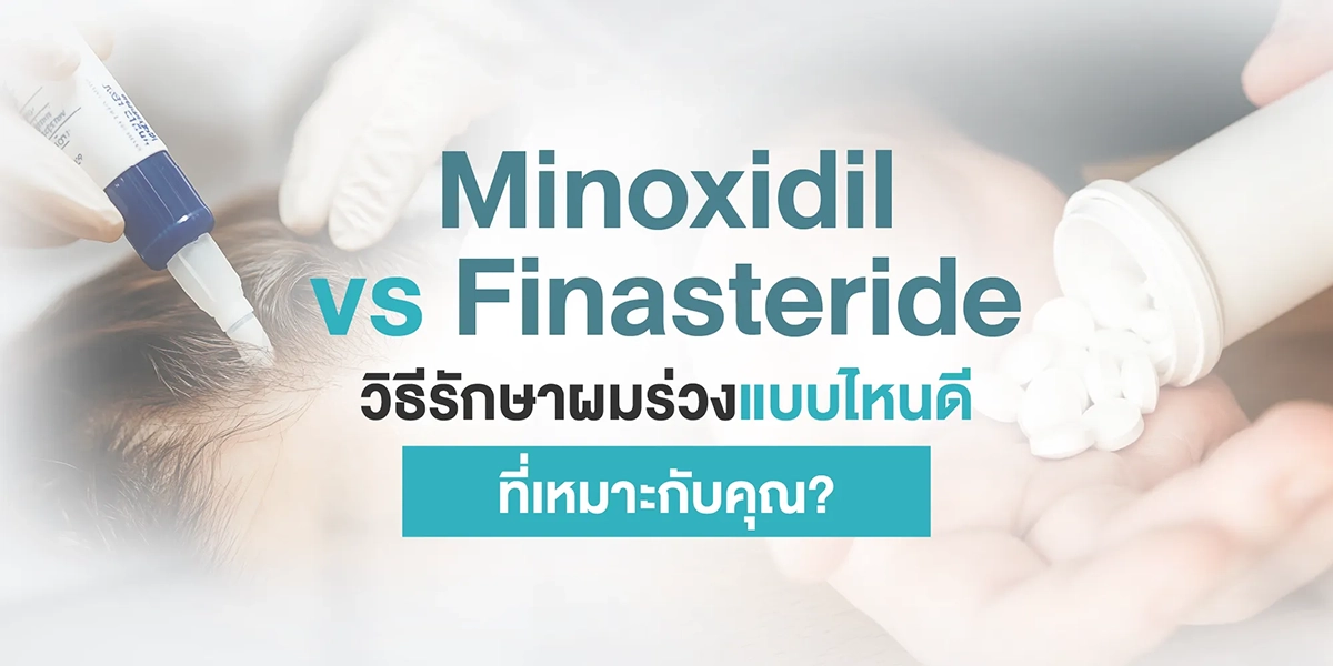 Minoxidil vs Finasteride วิธีรักษาผมร่วงแบบไหนดี ที่เหมาะกับคุณ