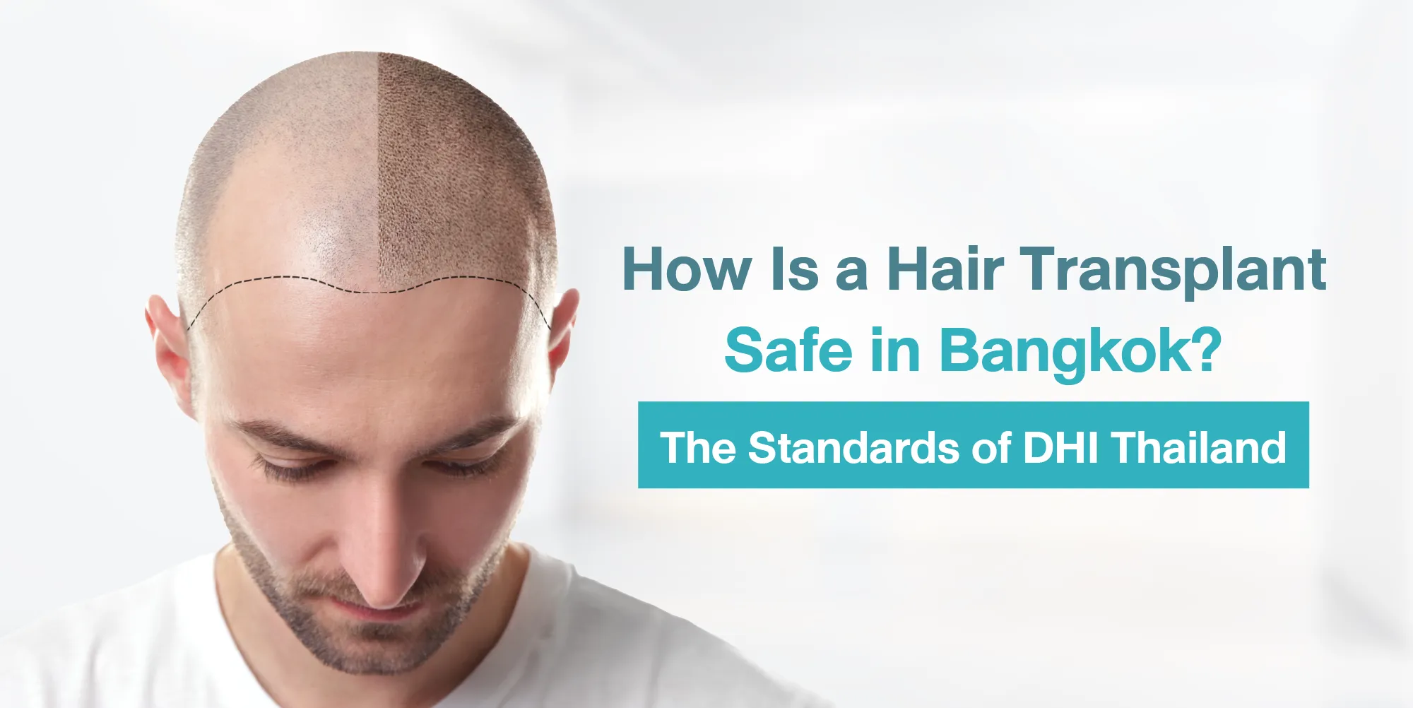 How Is a Hair Transplant Safe in Bangkok – The Standards of DHI Thailand