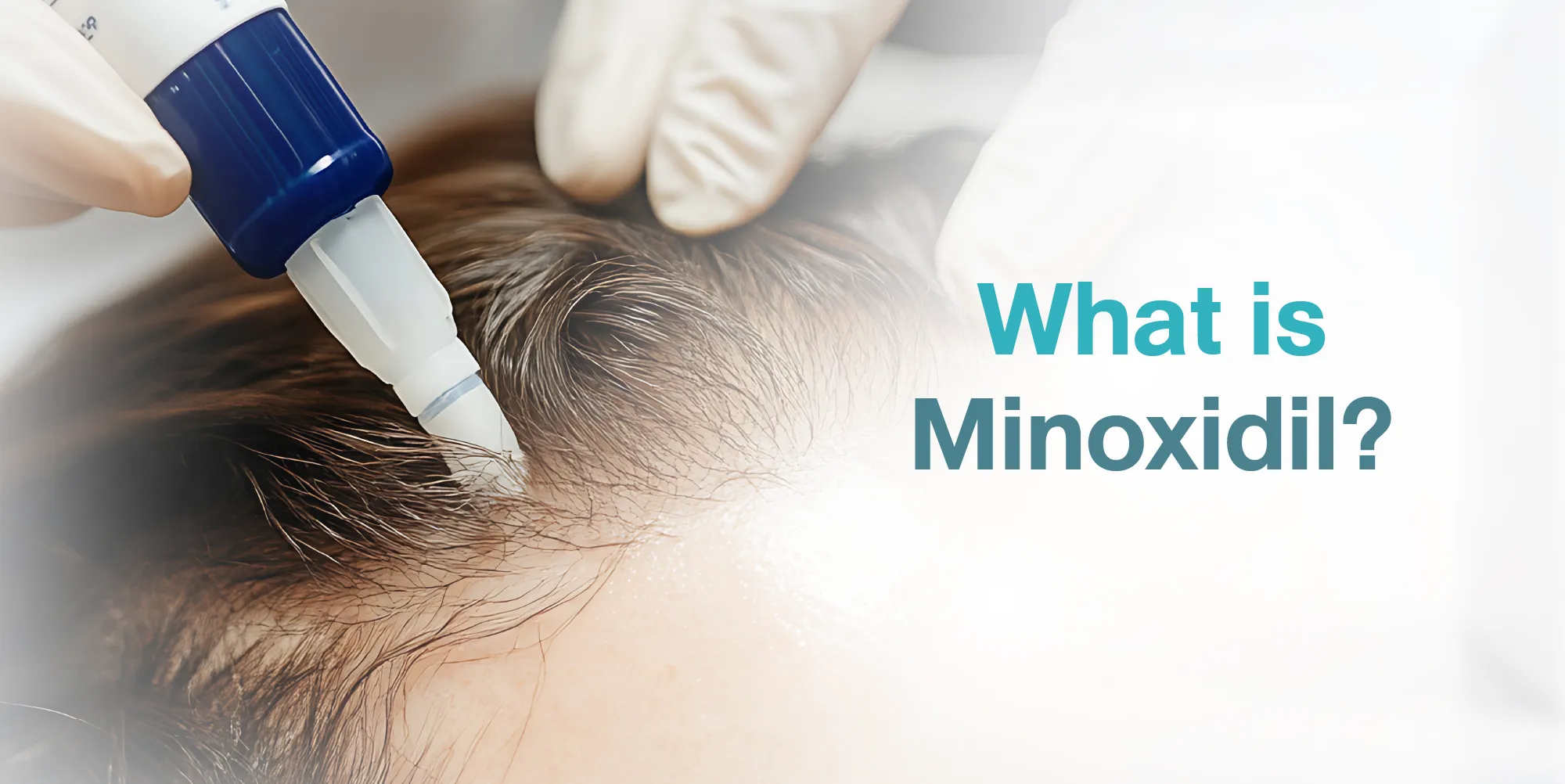 ​What is Minoxidil
