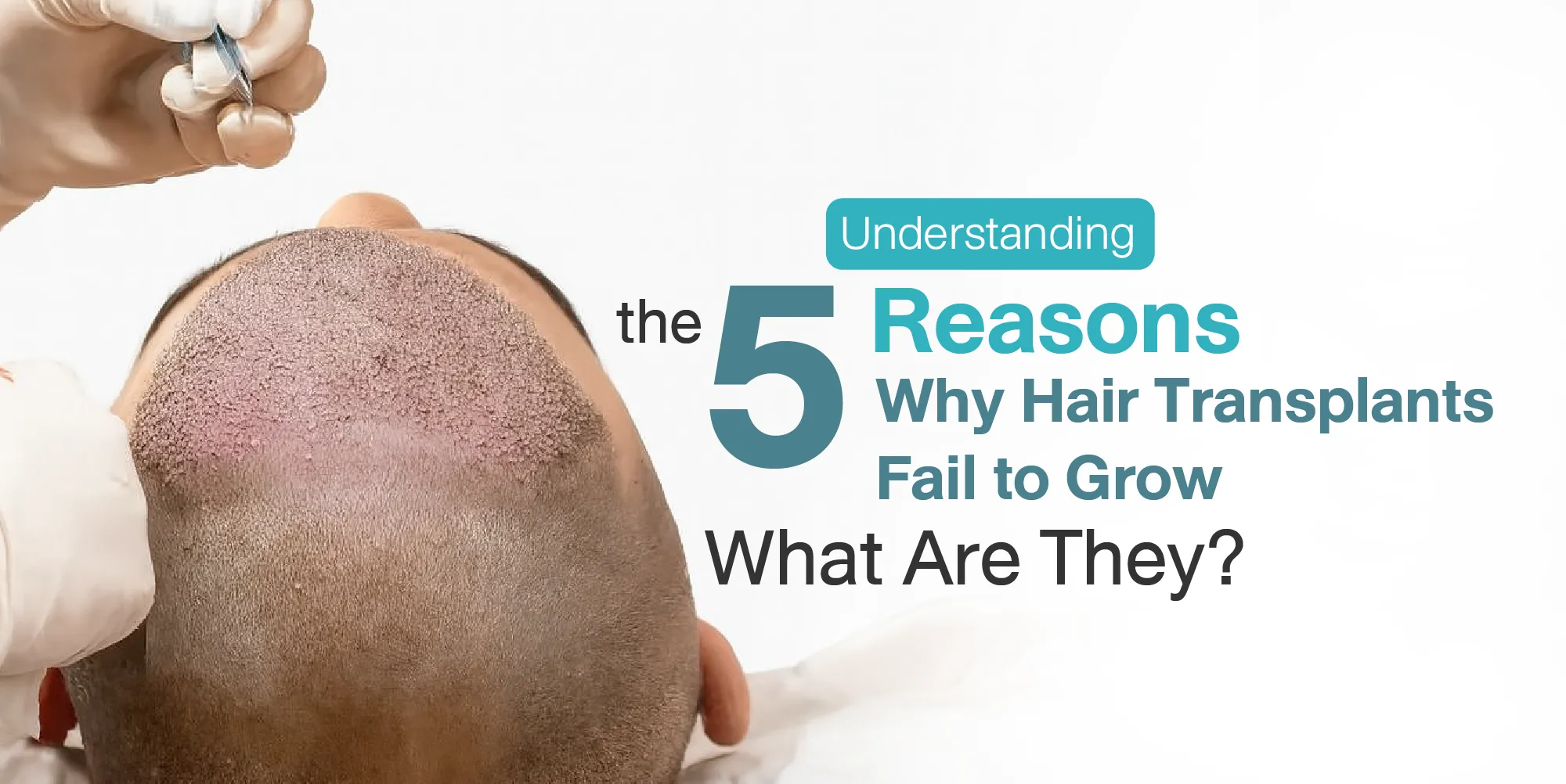 Understanding the 5 Reasons Why Hair Transplants Fail to Grow What Are They