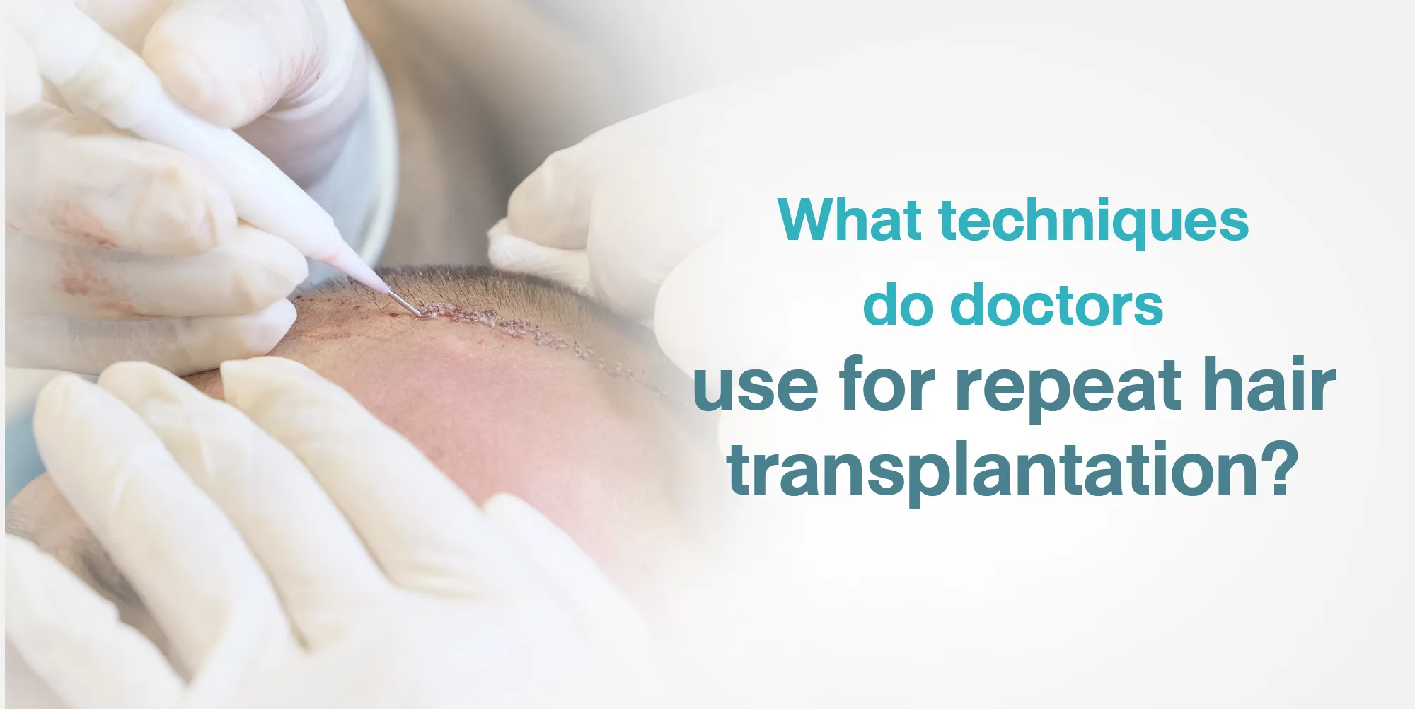 What techniques do doctors use for repeat hair transplantation