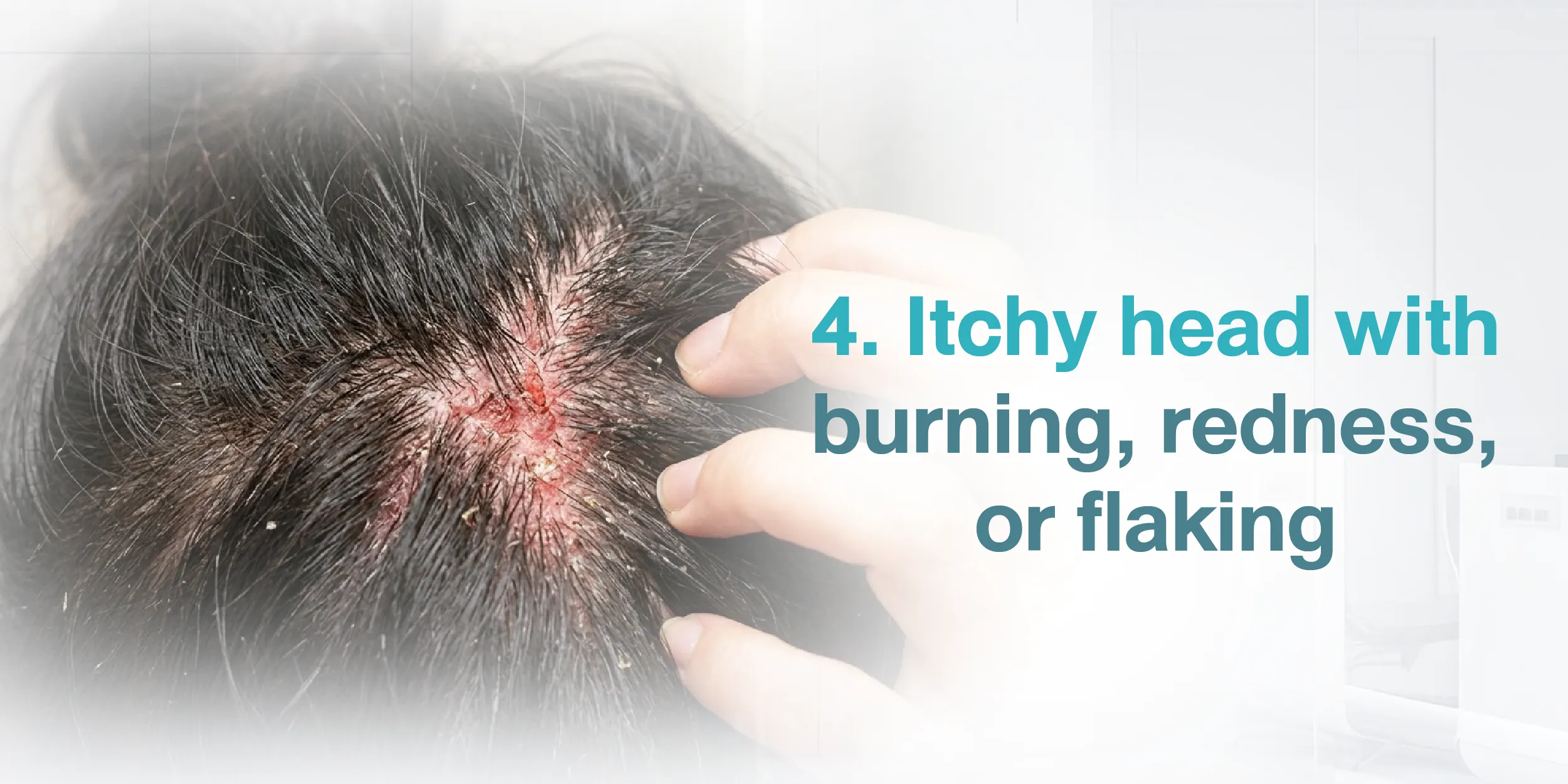 4. Itchy head with burning, redness, or flaking