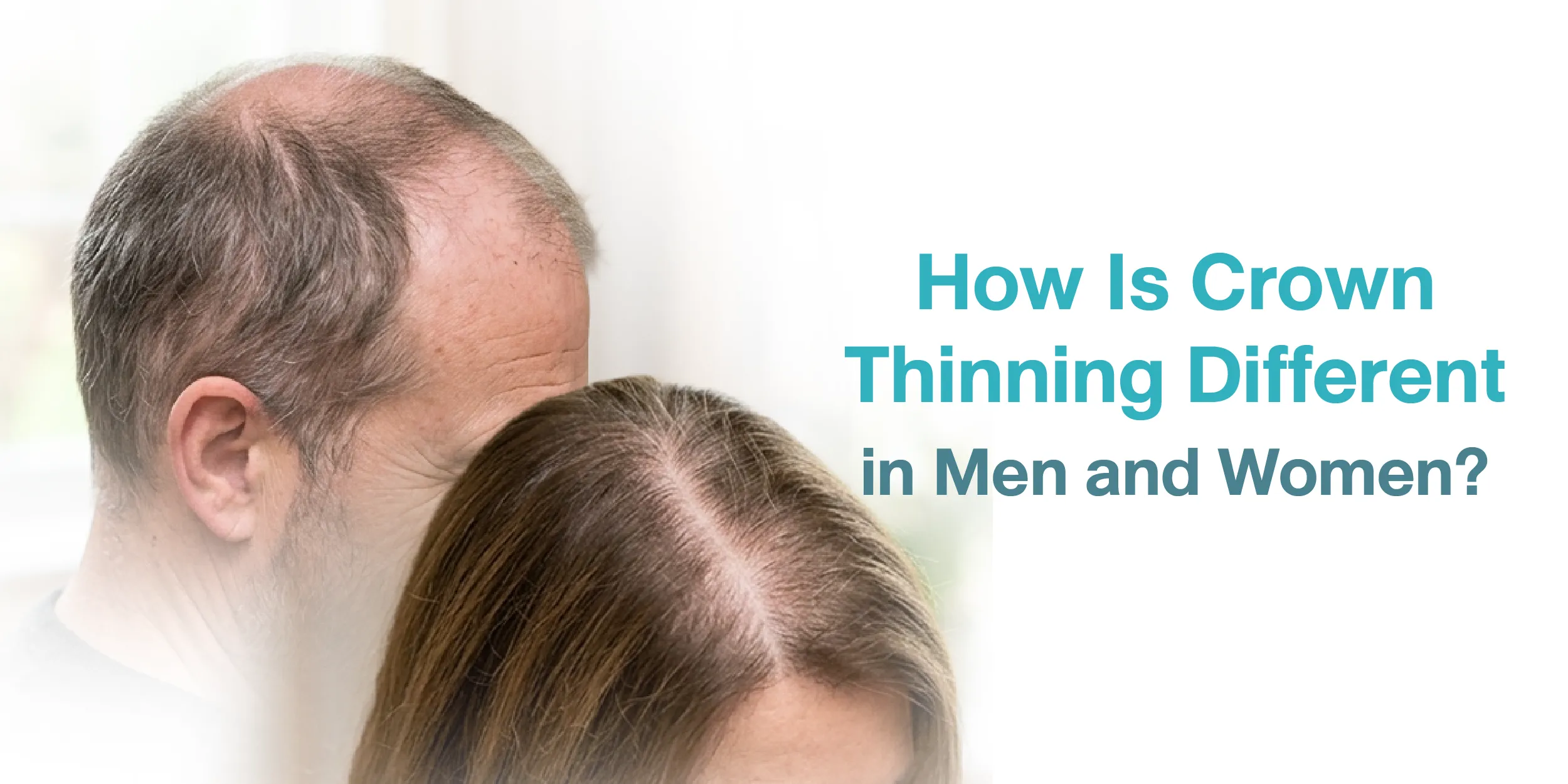 How Is Crown Thinning Different in Men and Women