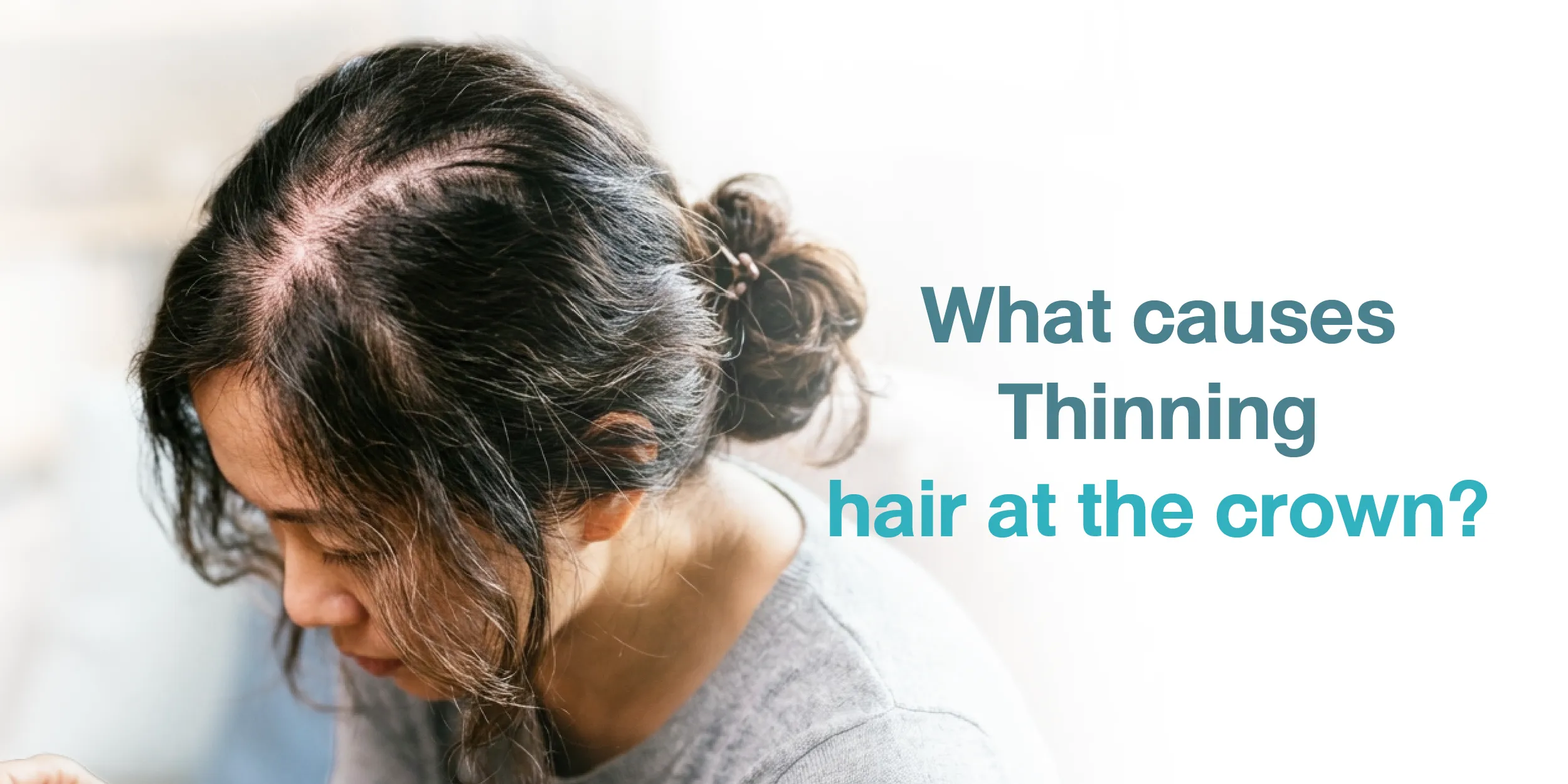 What causes Thinning hair at the crown