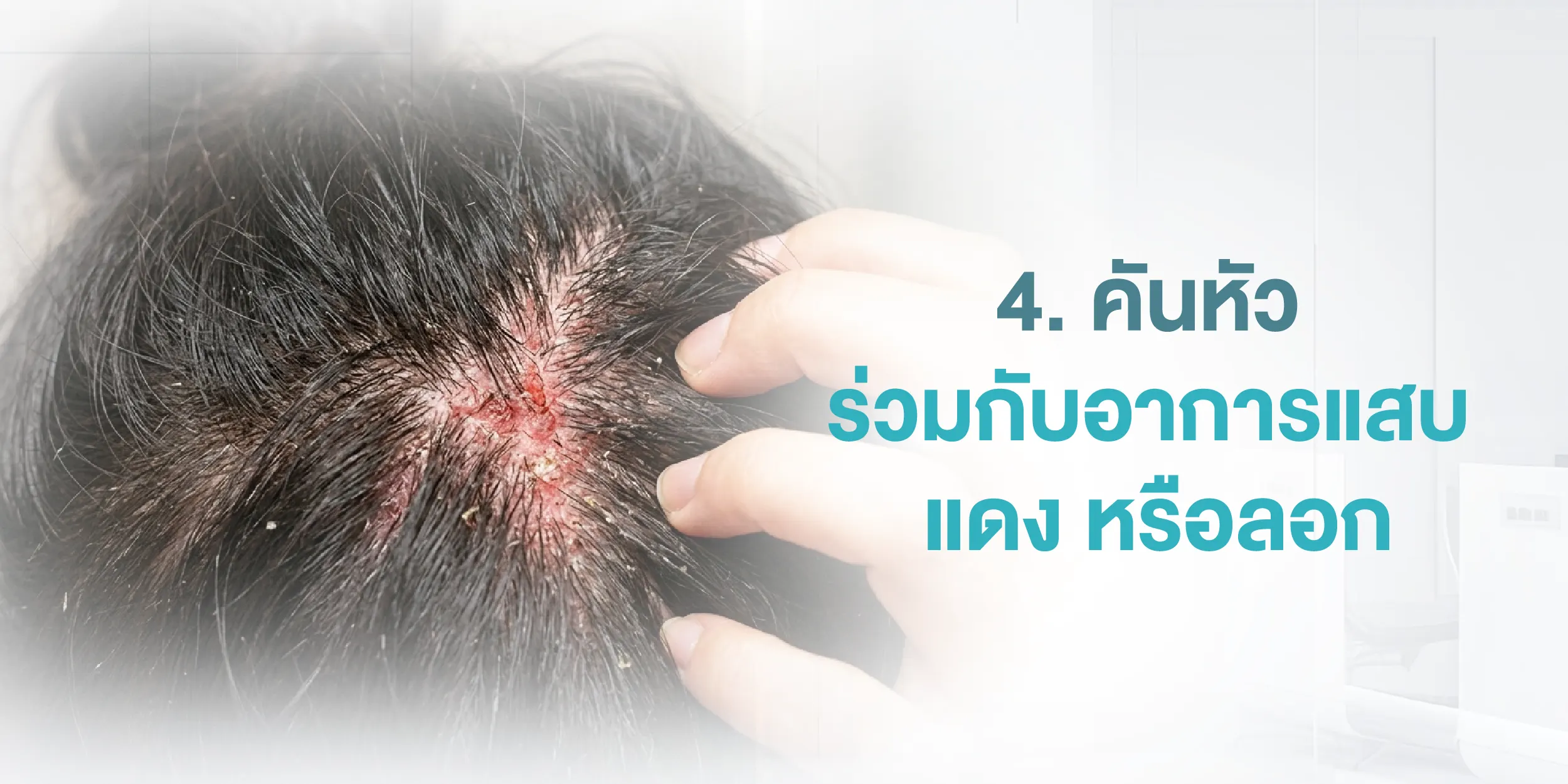4. คันหัวร่วมกับอาการแสบ แดง หรือลอก