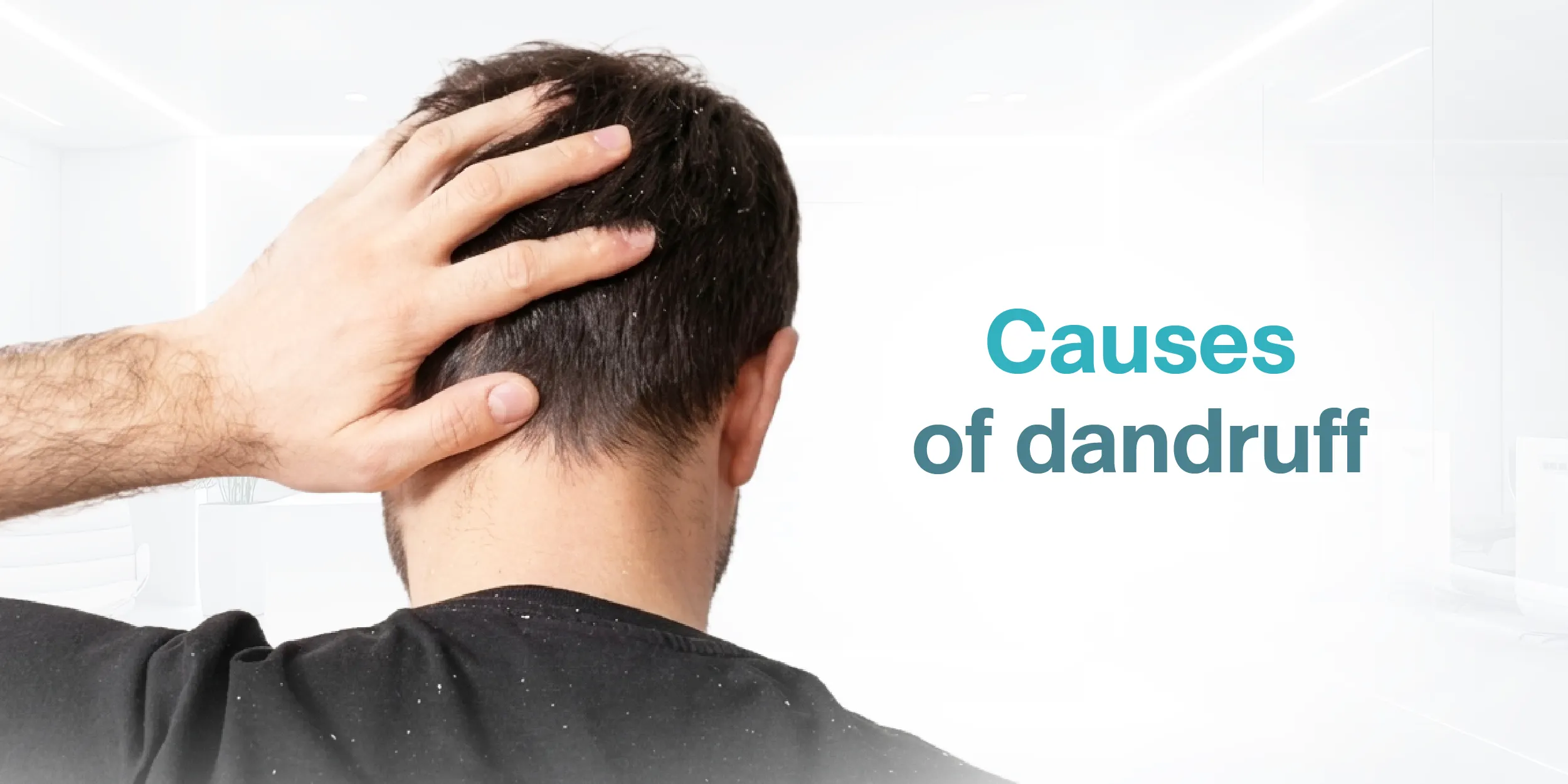 Causes of dandruff