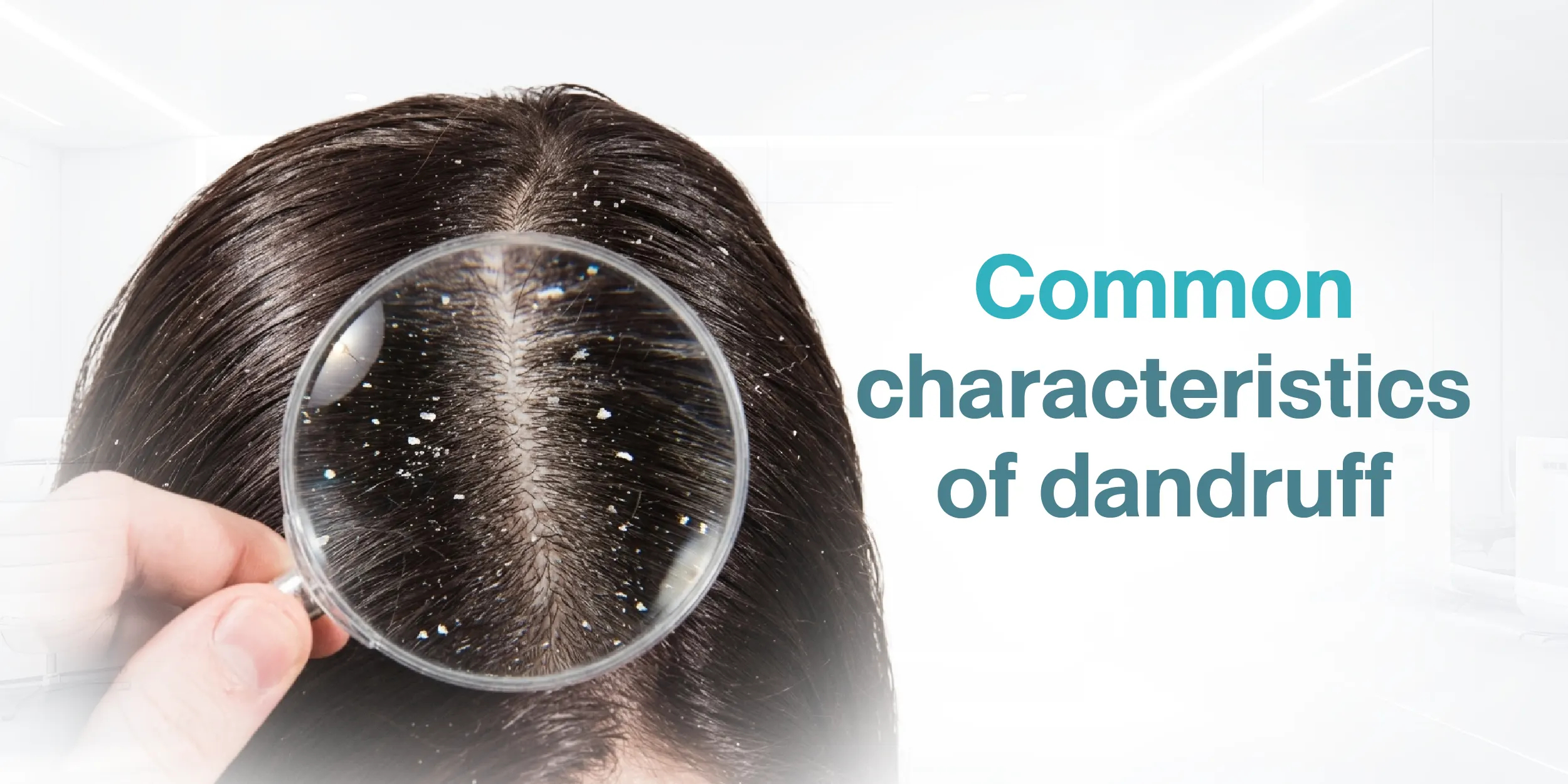 Common characteristics of dandruff