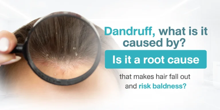 Does Dandruff Cause Hair Fall and Baldness