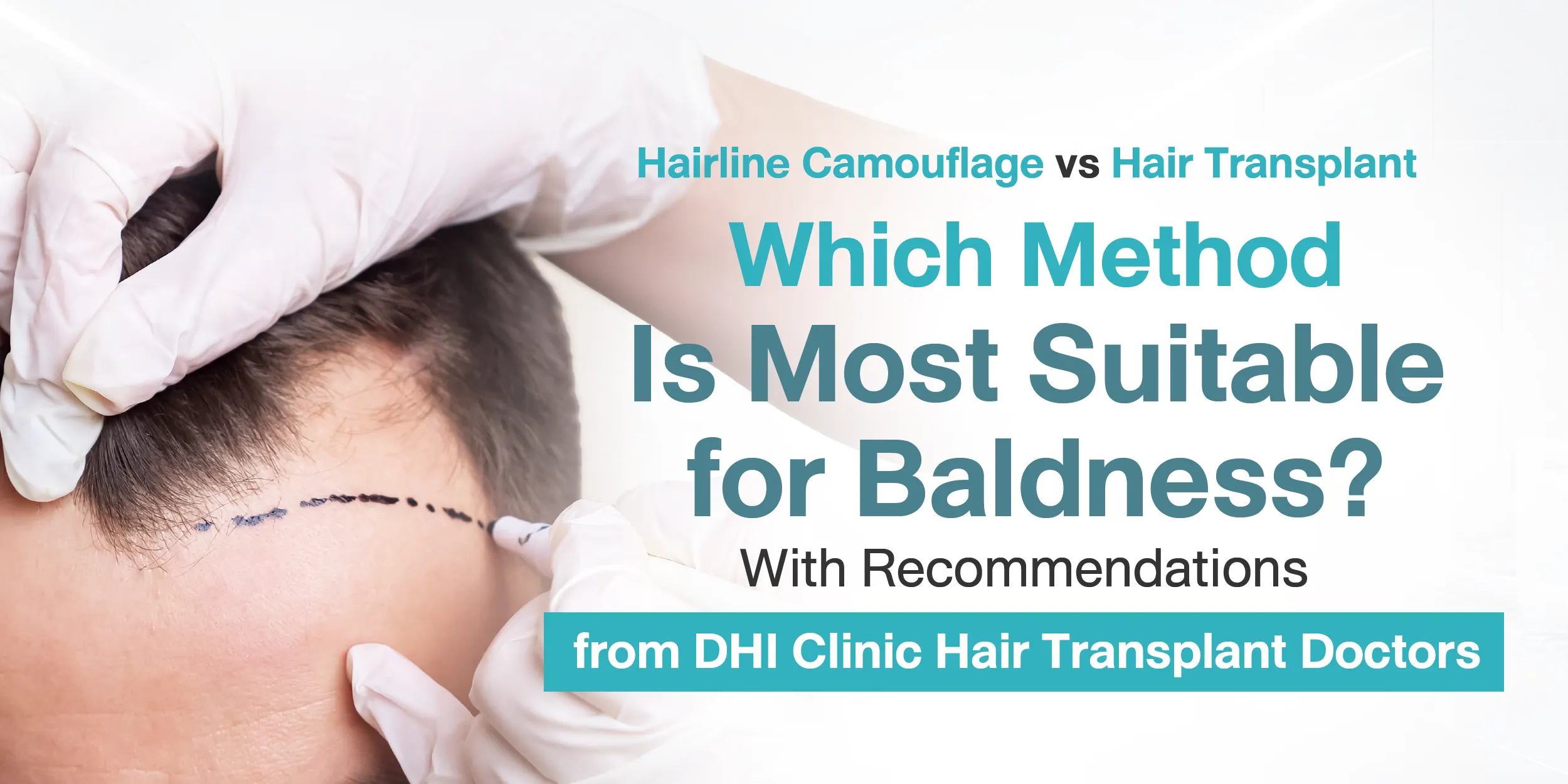 Hairline Camouflage vs Hair Transplant Which Method Is Most Suitable for Baldness With Recommendations from DHI Clinic Hair Transplant Doctors
