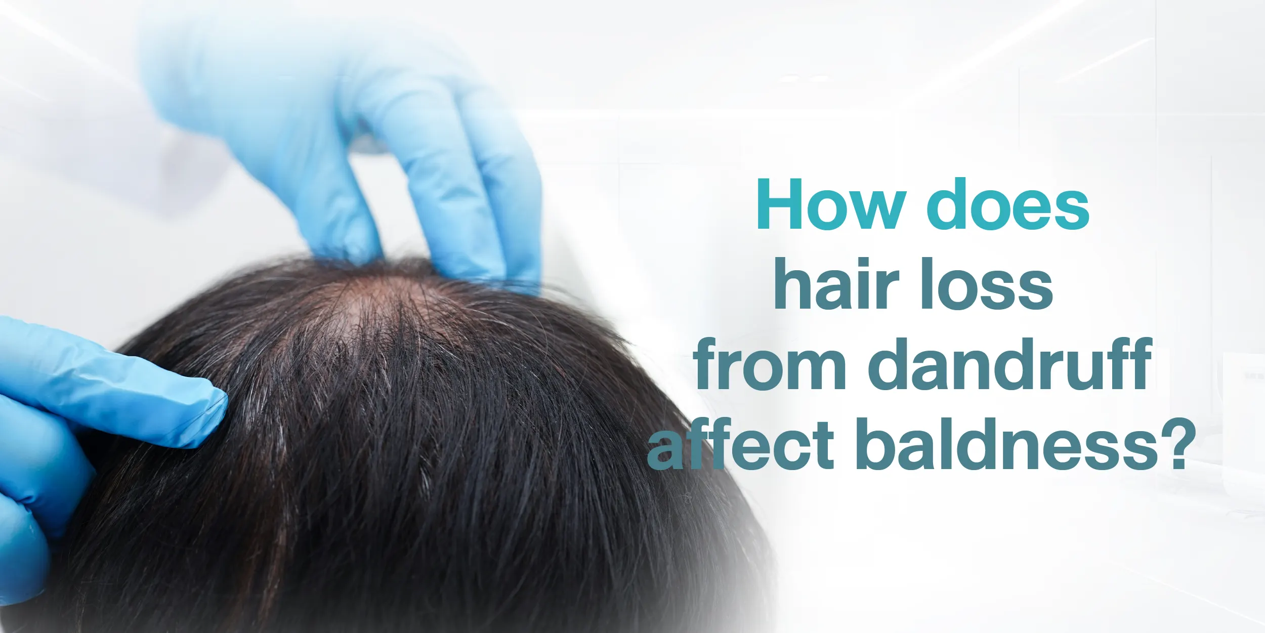 How does hair loss from dandruff affect baldness
