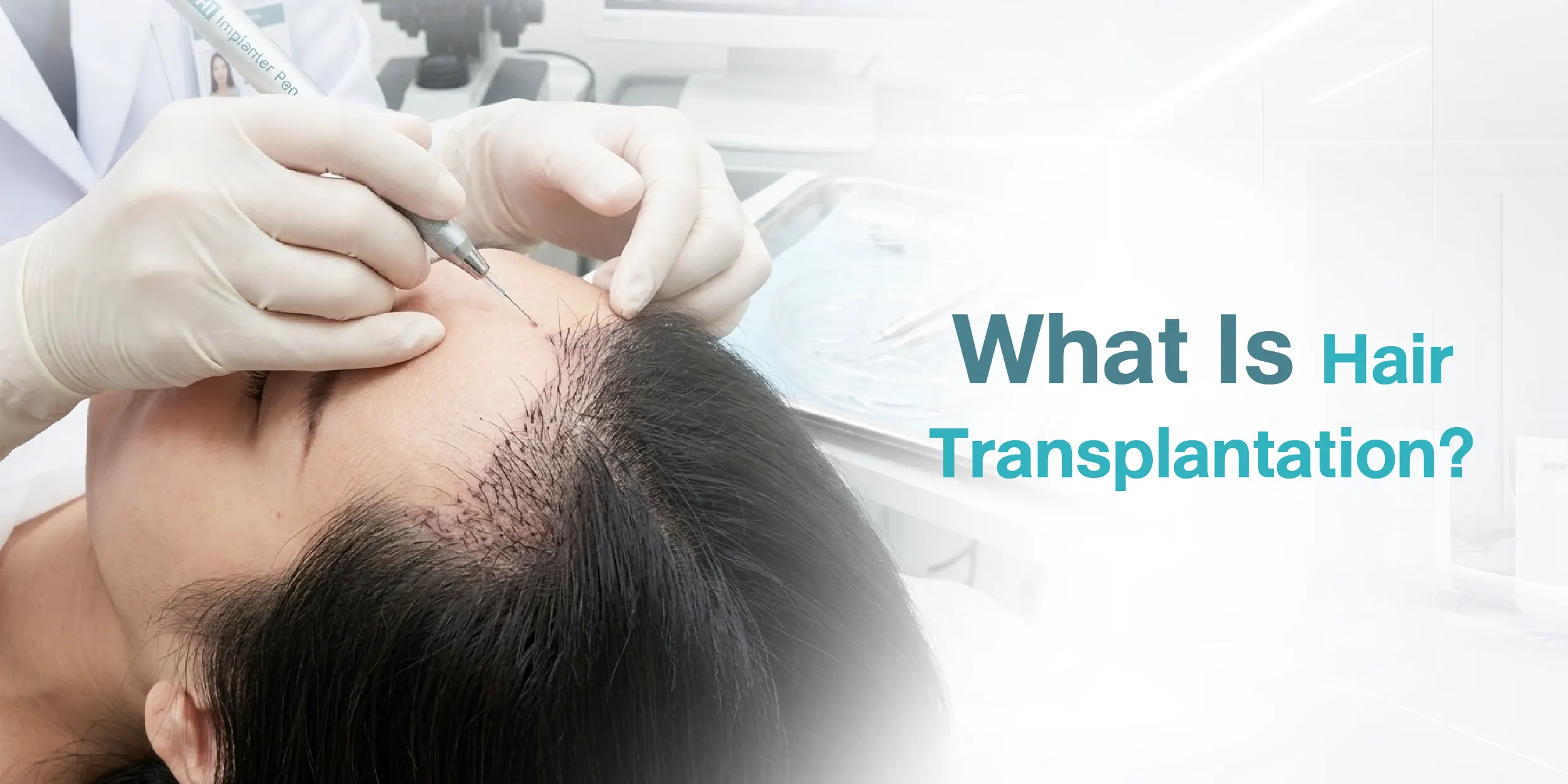 What Is Hair Transplantation