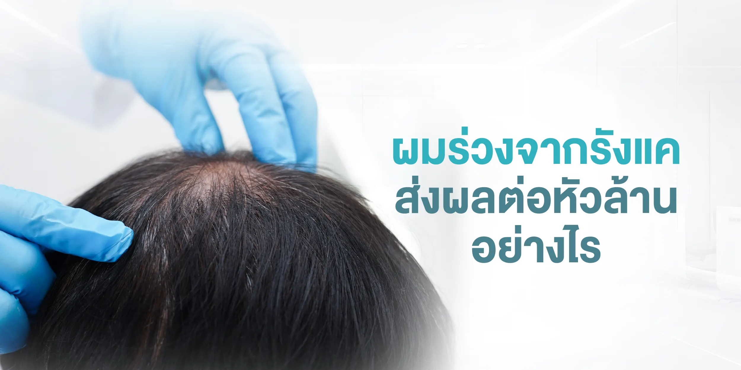 ผมร่วงจากรังแคส่งผลต่อหัวล้านอย่างไร