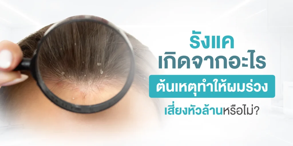 รังแค เกิดจากอะไร ต้นเหตุทำให้ผมร่วง เสี่ยงหัวล้านหรือไม่