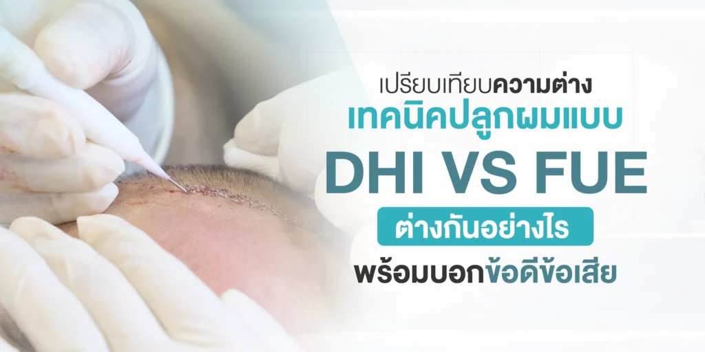 เปรียบเทียบความต่างเทคนิคปลูกผมแบบ DHI VS FUE ต่างกันอย่างไร พร้อมบอกข้อดีข้อเสีย
