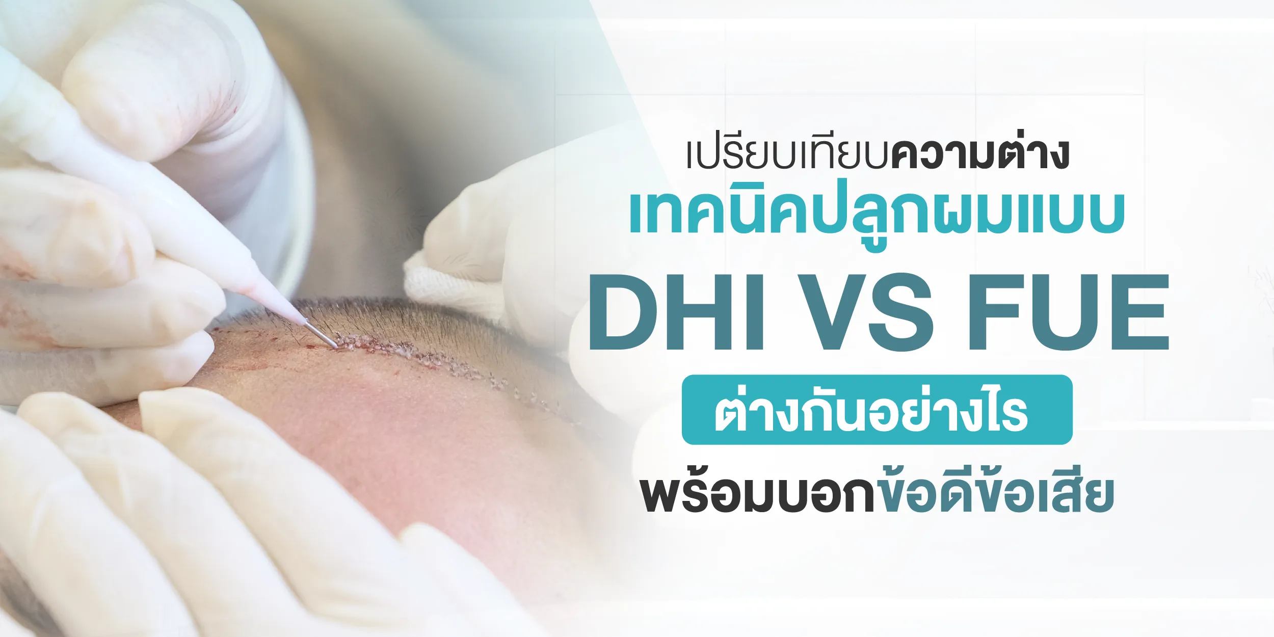 เปรียบเทียบความต่างเทคนิคปลูกผมแบบ DHI VS FUE ต่างกันอย่างไร พร้อมบอกข้อดีข้อเสีย