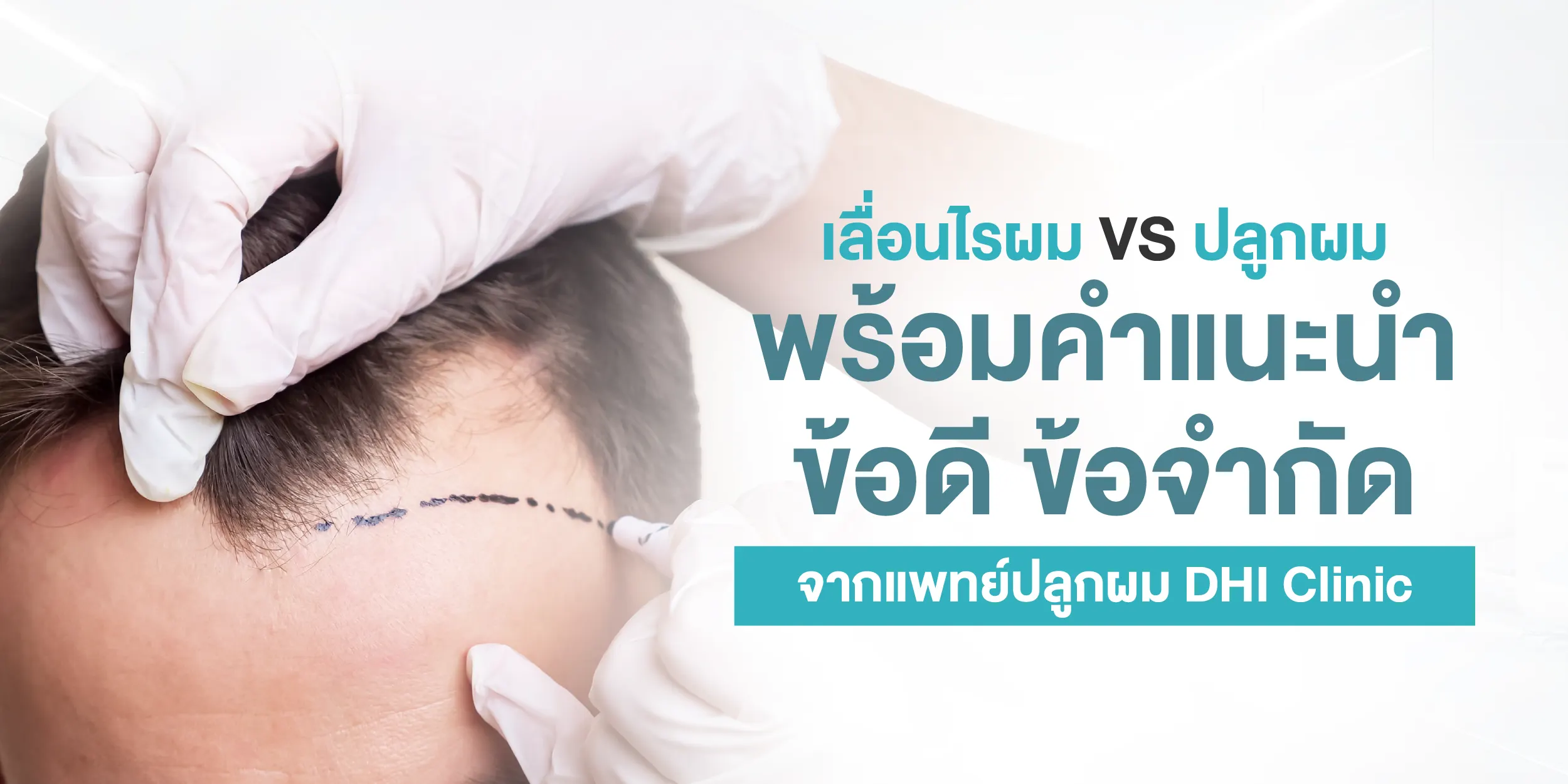 เลื่อนไรผม VS ปลูกผม พร้อมคำแนะนำ ข้อดี ข้อจำกัด จากแพทย์ปลูกผม DHI Clinic
