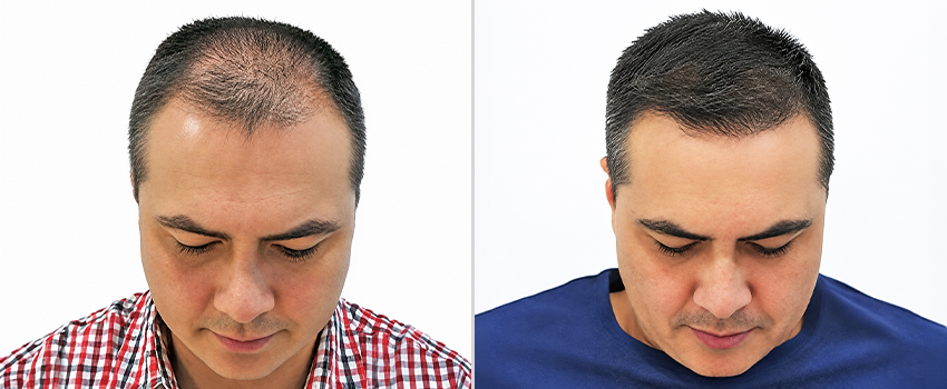 DHI hair transplant before and after result 1
