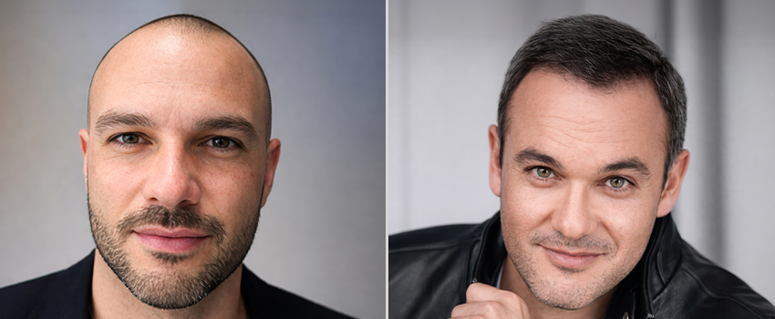 DHI hair transplant before and after result 3