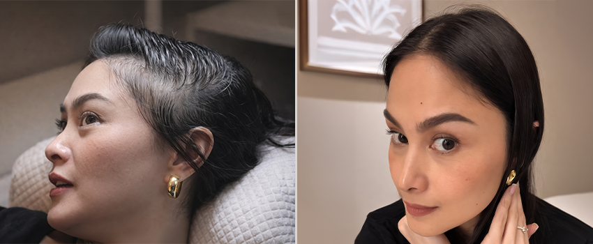 DHI hair transplant before and after result 4