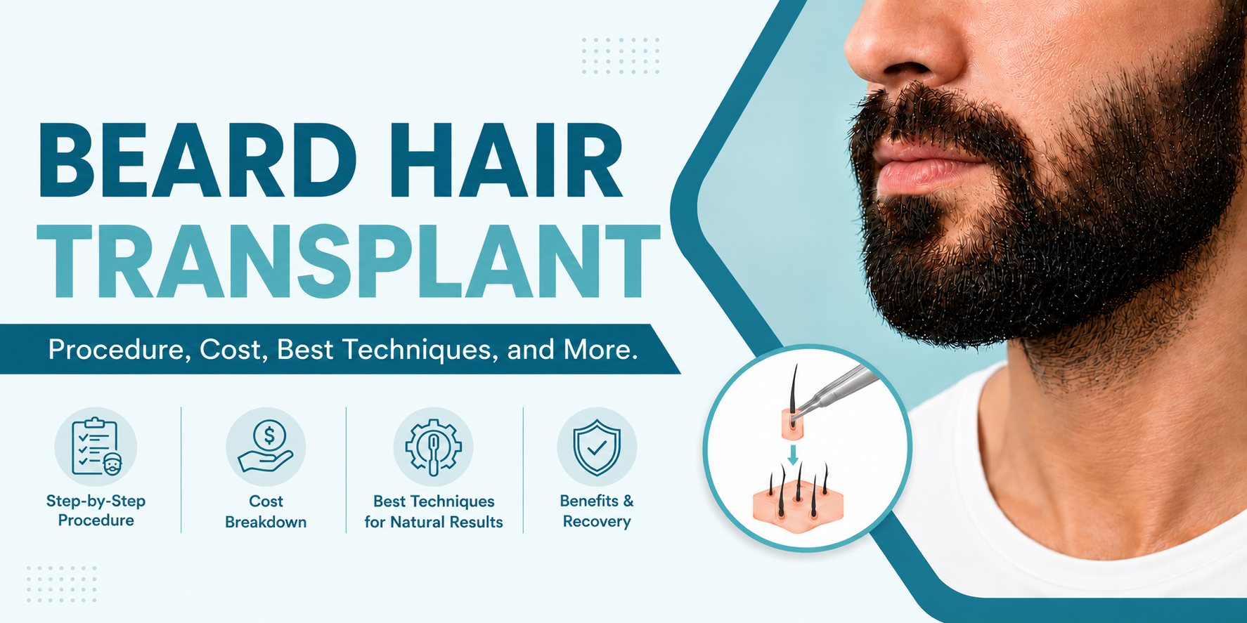 beard hair transplant